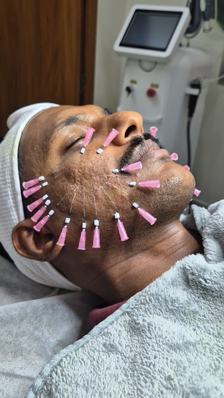 Threadlift Story